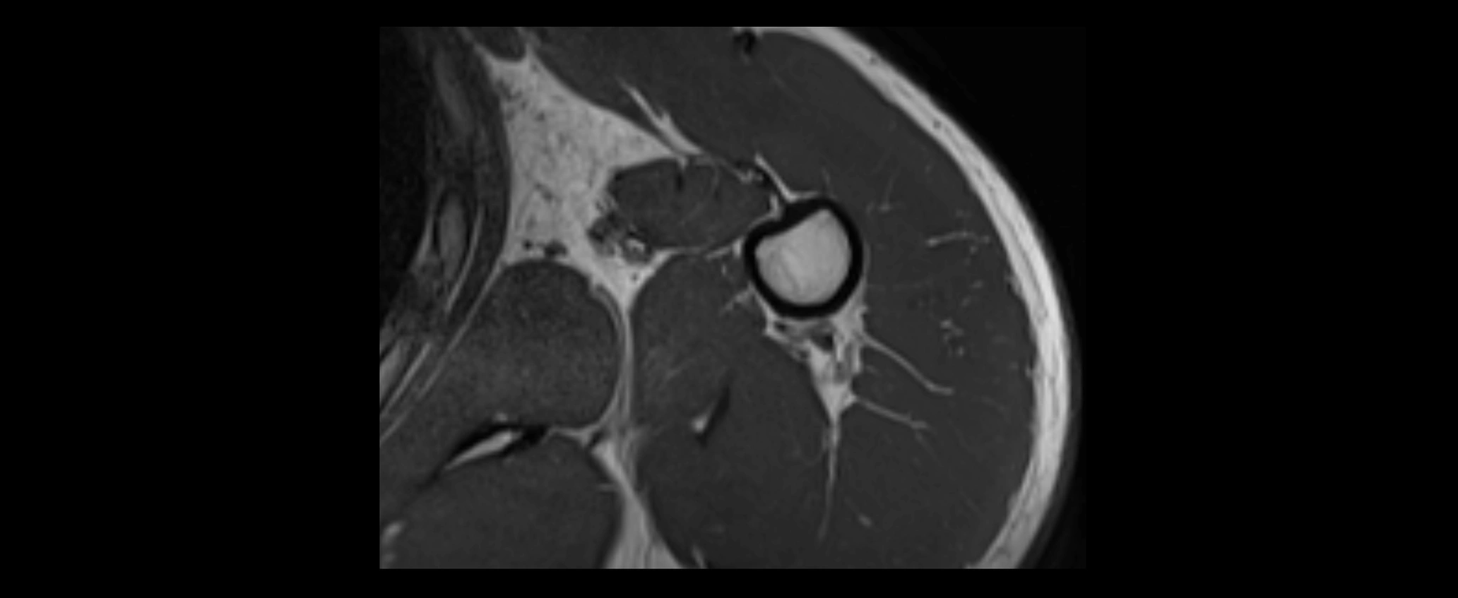 shoulder ligaments axial 3d 3t mri image-img-00005-00109.webp